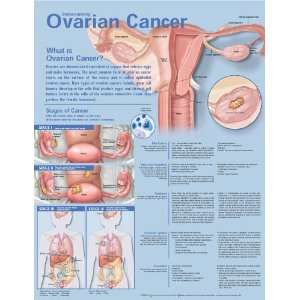  Understanding Ovarian Cancer Anatomical Chart   Unmounted 